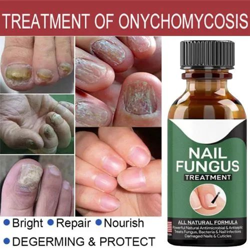 Fast Nail Fungal Treatments Nail Repair Essence Serum Care Treatments Foot Nail Fungus Removal Gel