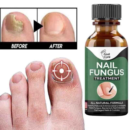 Fast Nail Fungal Treatments Nail Repair Essence Serum Care Treatments Foot Nail Fungus Removal Gel