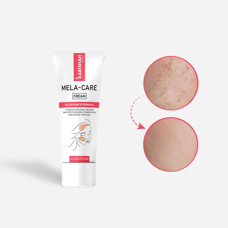 Kabishah Mela-Care Cream Advanced Formula For Melasma, Freckles, Dark Spots, And Uneven Skin Tone 50ml